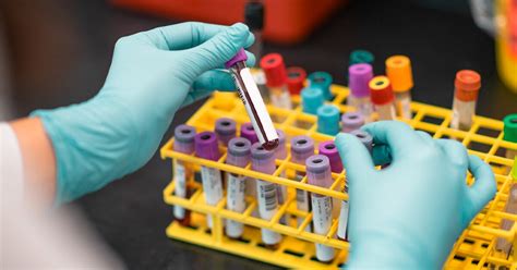 Leukemia Blood Cell Counts for Diagnosis, Treatment, and Follo.